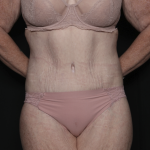 Body Lift Before & After Patient #36082