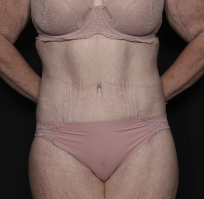 Body Lift Before & After Patient #36082