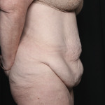 Body Lift Before & After Patient #36082