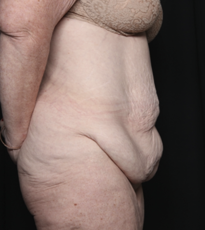 Body Lift Before & After Patient #36082