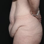 Body Lift Before & After Patient #36082