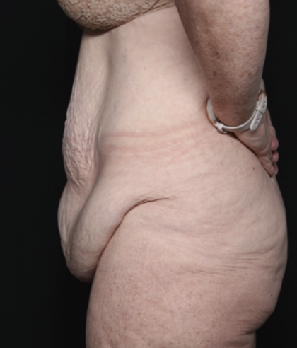 Body Lift Before & After Patient #36082