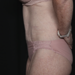 Body Lift Before & After Patient #36082