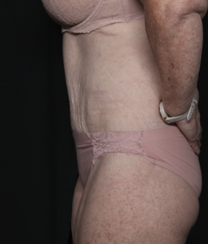 Body Lift Before & After Patient #36082