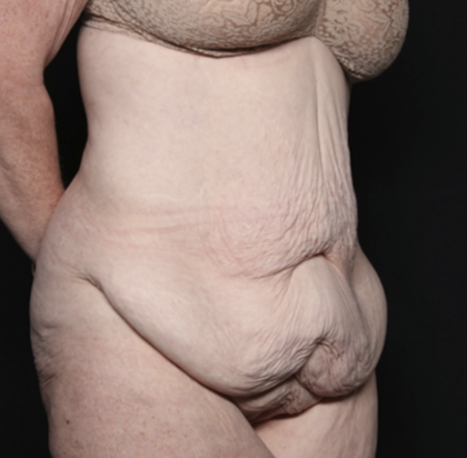 Body Lift Before & After Patient #36082