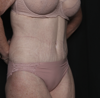 Body Lift Before & After Patient #36082