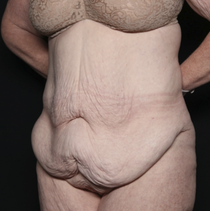 Body Lift Before & After Patient #36082