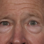 Lower Blepharoplasty Before & After Patient #36081
