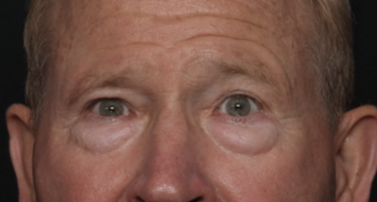 Lower Blepharoplasty Before & After Patient #36081