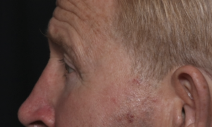 Lower Blepharoplasty Before & After Patient #36081