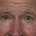 Lower Blepharoplasty Before & After Patient #36081
