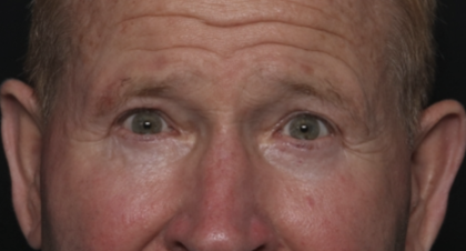 Lower Blepharoplasty Before & After Patient #36081