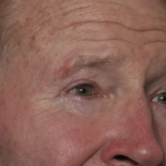 Lower Blepharoplasty Before & After Patient #36081