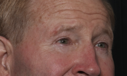 Lower Blepharoplasty Before & After Patient #36081