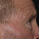 Lower Blepharoplasty Before & After Patient #36081