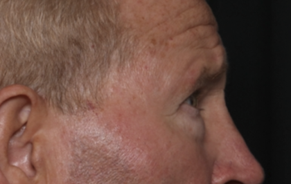 Lower Blepharoplasty Before & After Patient #36081