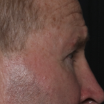 Lower Blepharoplasty Before & After Patient #36081