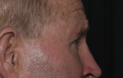 Lower Blepharoplasty Before & After Patient #36081