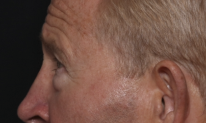 Lower Blepharoplasty Before & After Patient #36081
