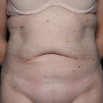 Tummy Tuck Before & After Patient #36080