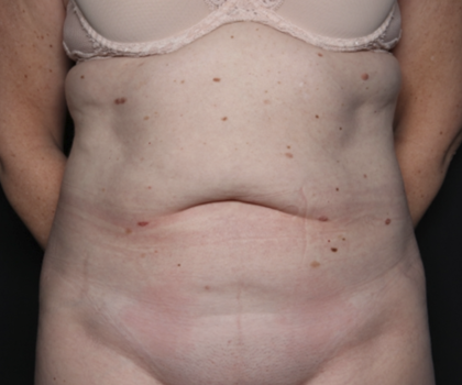 Tummy Tuck Before & After Patient #36080