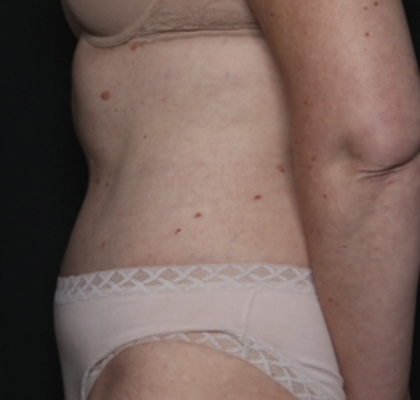 Tummy Tuck Before & After Patient #36080