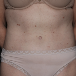 Tummy Tuck Before & After Patient #36080