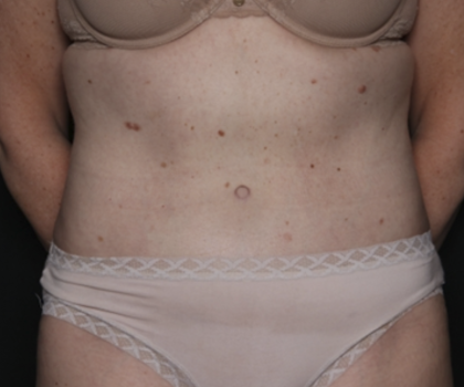 Tummy Tuck Before & After Patient #36080