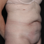 Tummy Tuck Before & After Patient #36080