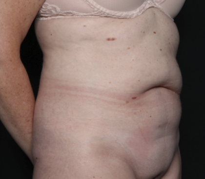 Tummy Tuck Before & After Patient #36080