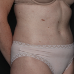 Tummy Tuck Before & After Patient #36080