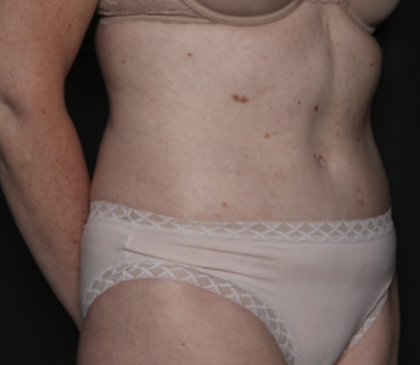 Tummy Tuck Before & After Patient #36080