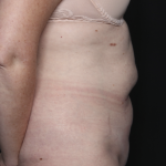 Tummy Tuck Before & After Patient #36080