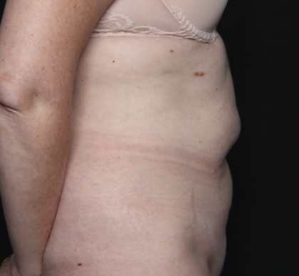 Tummy Tuck Before & After Patient #36080