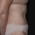 Tummy Tuck Before & After Patient #36080