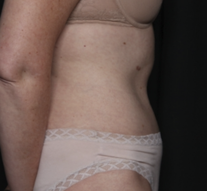 Tummy Tuck Before & After Patient #36080