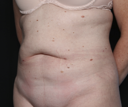 Tummy Tuck Before & After Patient #36080