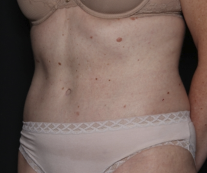 Tummy Tuck Before & After Patient #36080