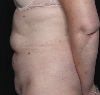 Tummy Tuck Before & After Patient #36080