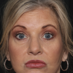 Injectable Fillers Before & After Patient #36213