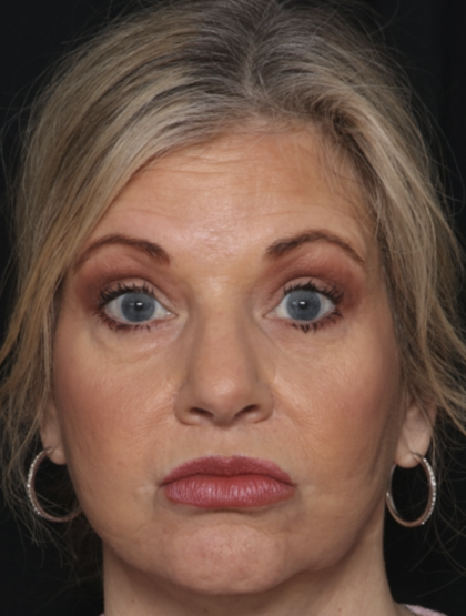 Injectable Fillers Before & After Patient #36213