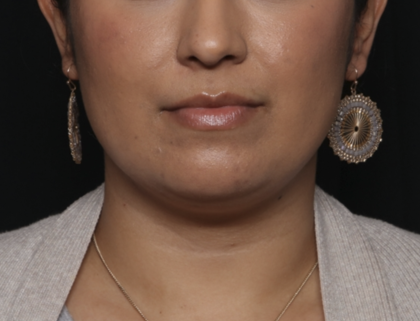 Liposuction Before & After Patient #36240