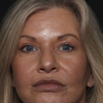 Injectable Fillers Before & After Patient #36213