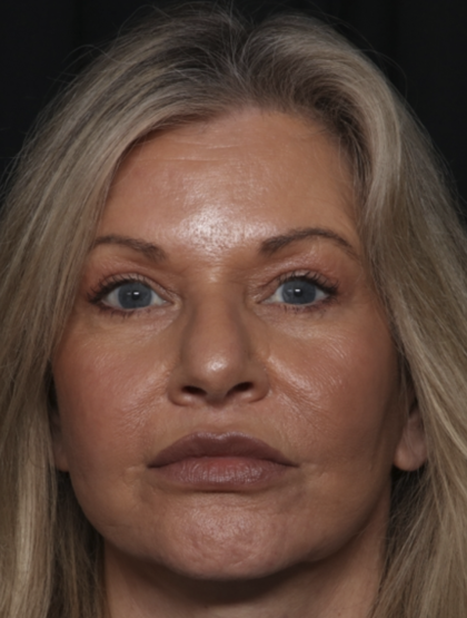Injectable Fillers Before & After Patient #36213