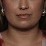 Liposuction Before & After Patient #36240
