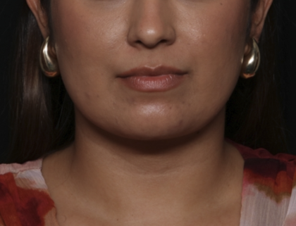 Liposuction Before & After Patient #36240