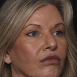 Injectable Fillers Before & After Patient #36213