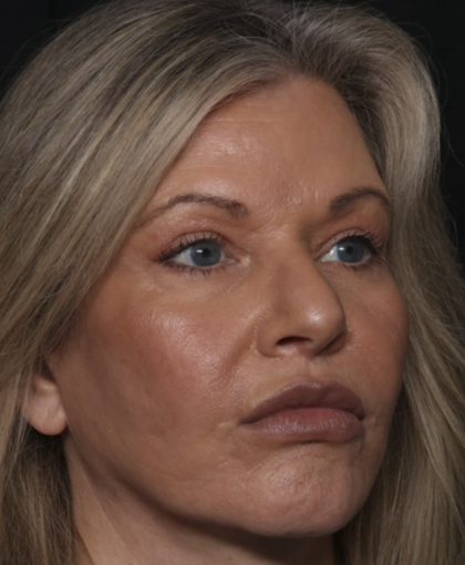 Injectable Fillers Before & After Patient #36213