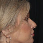 Injectable Fillers Before & After Patient #36213