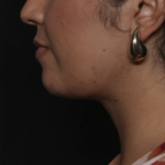 Liposuction Before & After Patient #36240
